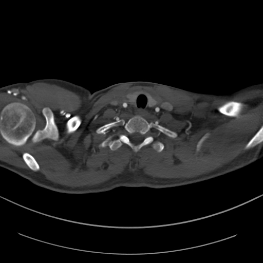 File:Brachiocephalic trunk pseudoaneurysm (Radiopaedia 70978-81191 Axial bone window 40).jpg