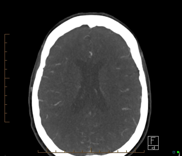 Brachiocephalic trunk stenosis (Radiopaedia 87242-103519 A 27).jpg