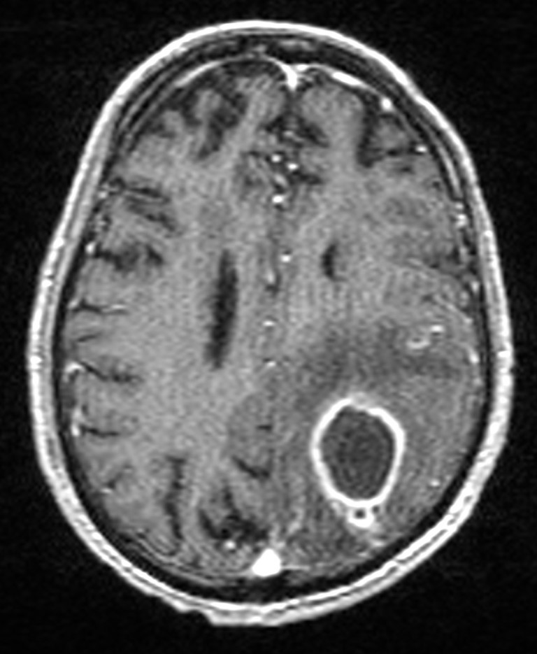 Brain abscess with dual rim sign (Radiopaedia 87566-103938 Axial T1 C+ 111).jpg