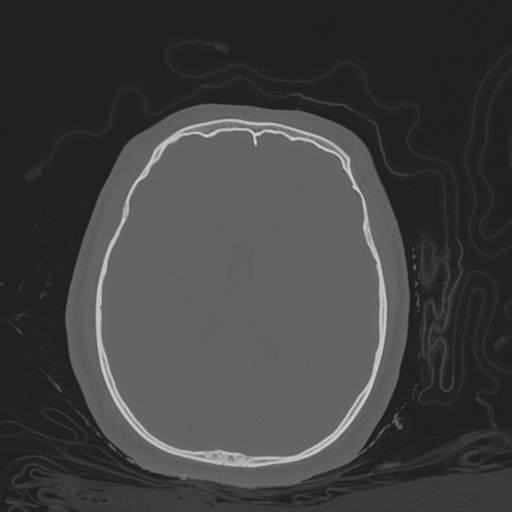 Brain contusions, internal carotid artery dissection and base of skull fracture (Radiopaedia 34089-35339 Axial bone window 82).png