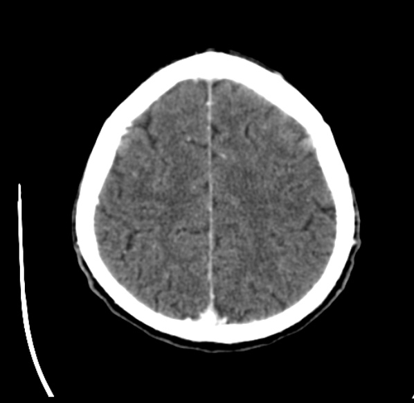 File:Brain metastases from lung cancer (Radiopaedia 24480-24781 Axial C+ delayed 49).jpg