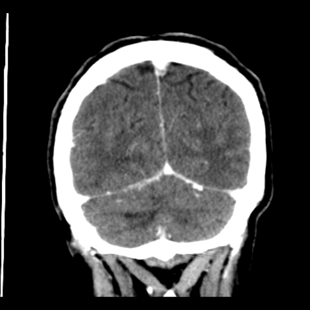 Brain metastases from lung cancer (Radiopaedia 24480-24781 Coronal C+ delayed 52).jpg