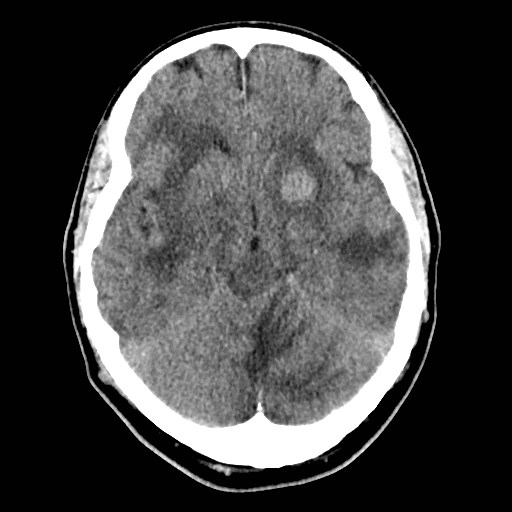 File:Brain metastases from lung cancer (Radiopaedia 83839-99027 Axial non-contrast 13).jpg