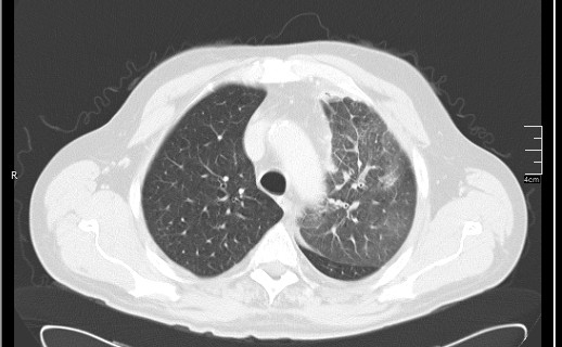 File:Brain metastases from squamocellular lung cancer (Radiopaedia 56515-63219 Axial lung window 21).jpg