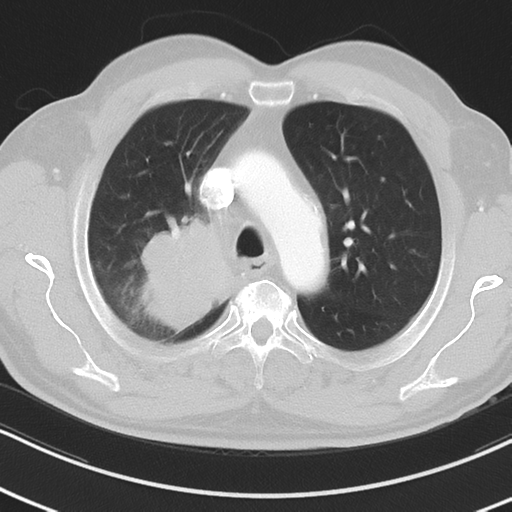 Brain metastasis (large cystic mass) (Radiopaedia 47497-52104 Axial lung window 13).png