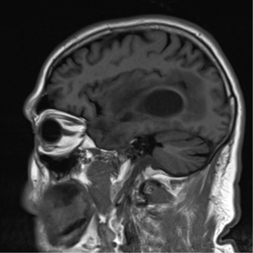 File:Brain metastasis (large cystic mass) (Radiopaedia 47497-52107 Sagittal T1 9).png