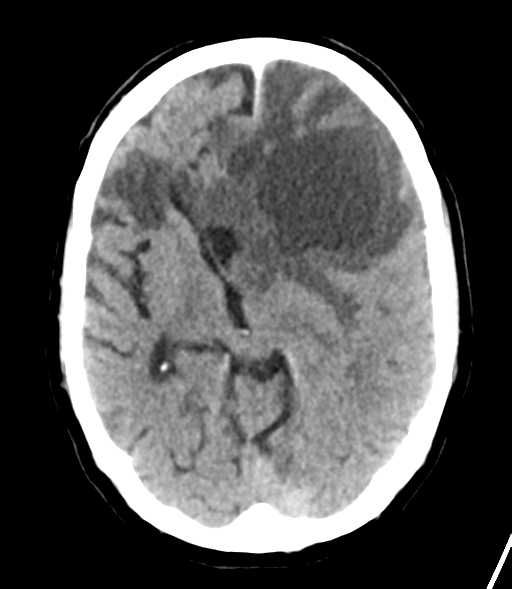 File:Brain metastasis (lung cancer) (Radiopaedia 48289-53177 Axial non-contrast 15).png