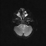 Brainstem glioma (Radiopaedia 67531-76922 Axial DWI 6).jpg