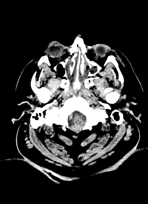 Brainstem hemorrhage (Radiopaedia 81294-94976 Axial non-contrast 56).jpg