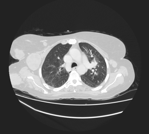 Breast metastases from facial malignant melanoma (Radiopaedia 60316-67975 Axial lung window 32).jpg