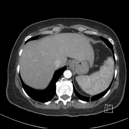 Breast metastases from renal cell cancer (Radiopaedia 79220-92225 A 79).jpg