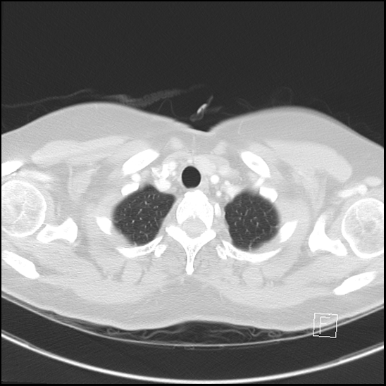 File:Breast metastases from renal cell cancer (Radiopaedia 79220-92225 Axial lung window 6).jpg