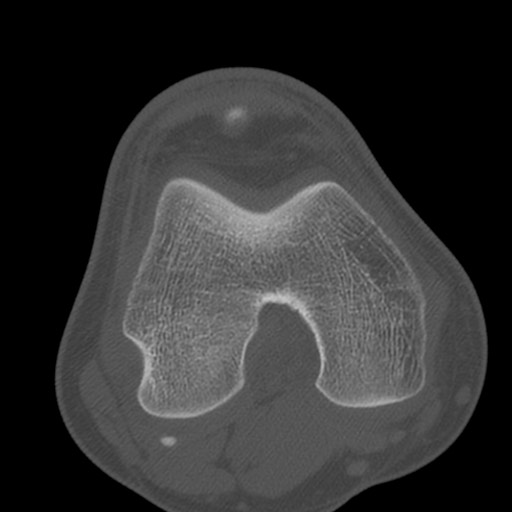 Brodie abscess of the tibia (Radiopaedia 58984-66250 Axial bone window 43).jpg