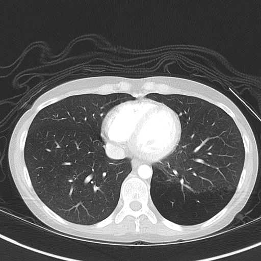 File:Bronchial atresia (Radiopaedia 73677-84470 Axial lung window 43).jpg