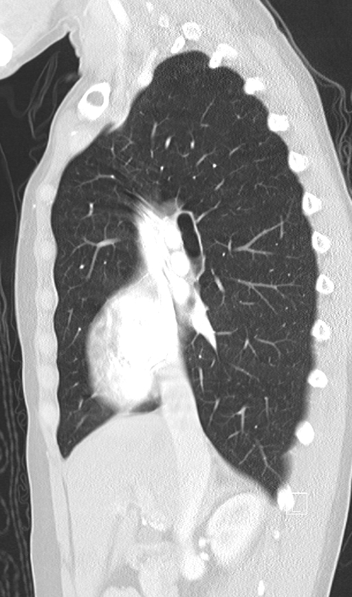 Bronchial atresia (Radiopaedia 73677-84470 Sagittal lung window 22).jpg