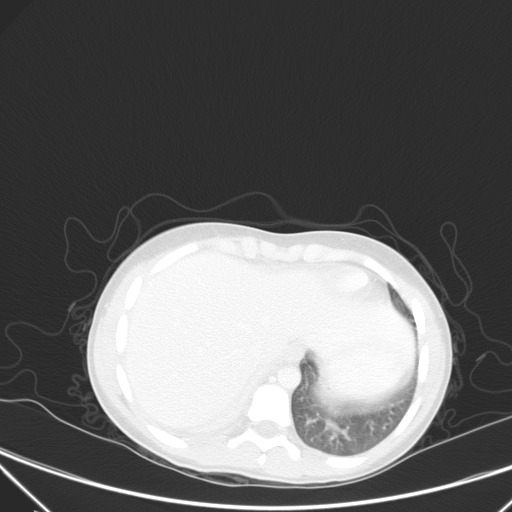 Bronchial mucoepidermoid carcinoma (Radiopaedia 57023-63895 Axial lung window 97).jpg