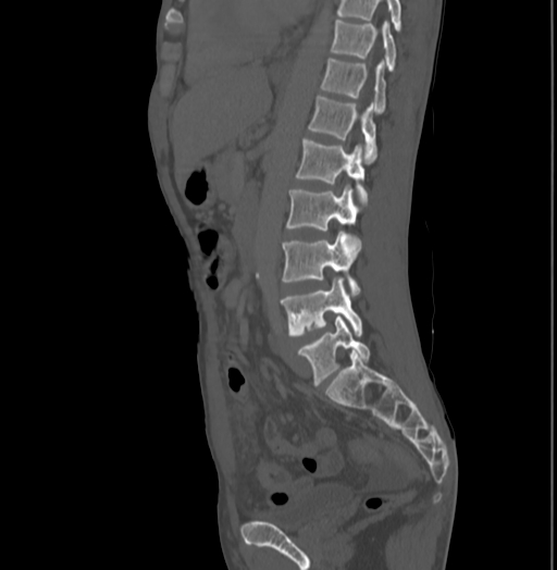 Bronchiectasis in Crohn disease (Radiopaedia 60311-67977 Sagittal bone window 140).jpg