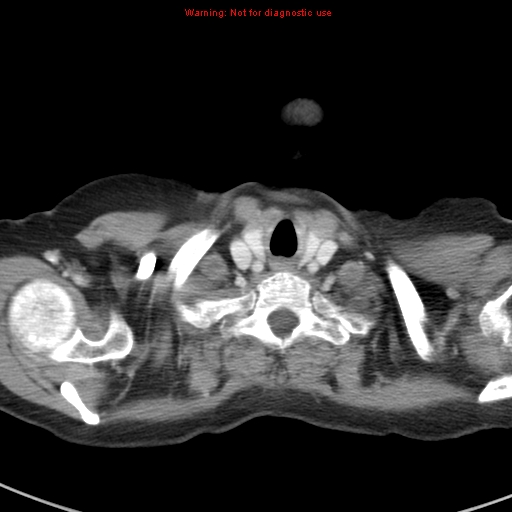 File:Bronchoalveolar carcinoma (BAC) (Radiopaedia 13436-13392 B 2).jpg