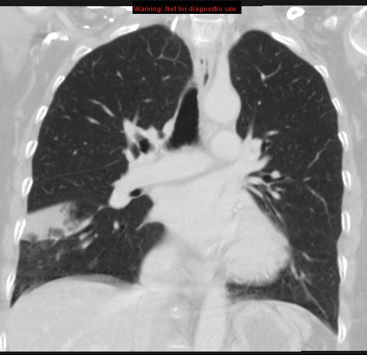 Bronchoalveolar carcinoma (BAC) (Radiopaedia 13436-13392 Coronal lung window 30).jpg