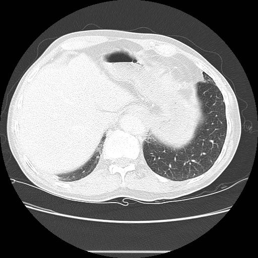 Bronchocele (Radiopaedia 17097-16795 Axial lung window 102).jpg