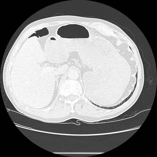 File:Bronchocele (Radiopaedia 17097-16795 Axial lung window 114).jpg