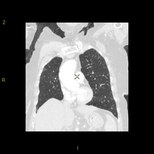 File:Bronchogenic carcinoma as an incidental finding (Radiopaedia 16453-16130 Coronal lung window 22).jpg
