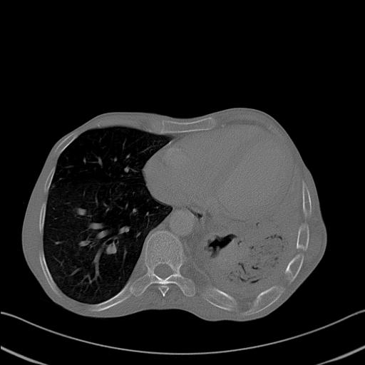 File:Bronchopleural fistula secondary to tuberculosis (Radiopaedia 20415-20322 Axial bone window 21).jpg