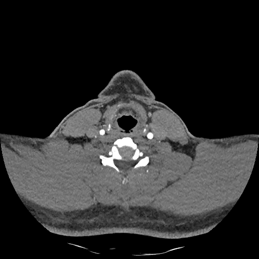Buccal fat pad arteriovenous malformation (Radiopaedia 70936-81144 D 108).jpg