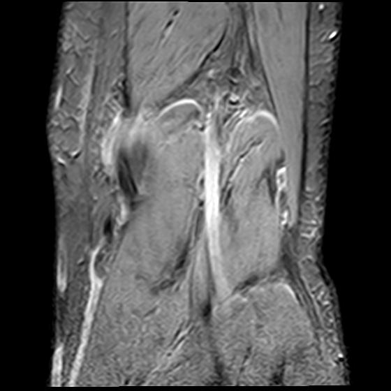 File:Bucket handle tear - medial meniscus (Radiopaedia 29250-29664 B 20).jpg