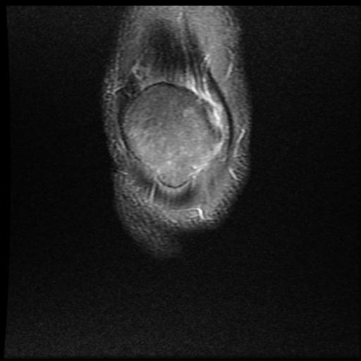 File:Bucket handle tear - medial meniscus (Radiopaedia 69245-79026 Coronal PD fat sat 1).jpg