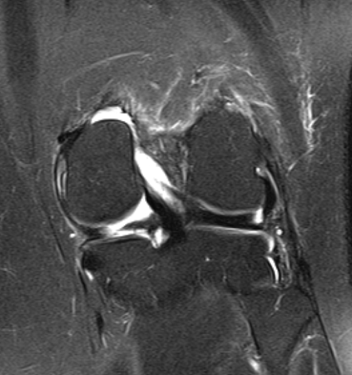 File:Bucket handle tear - medial meniscus (Radiopaedia 79028-91942 Coronal PD fat sat 5).jpg