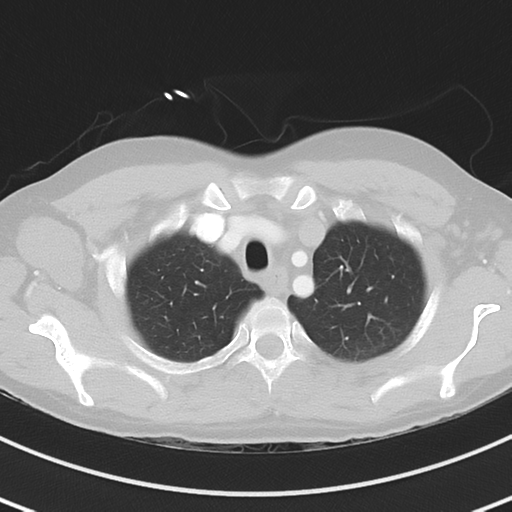 Burkitt lymphoma (Radiopaedia 34686-36121 Axial lung window 10).png
