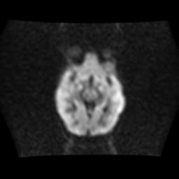 File:Burkitt lymphoma of the orbit- pre and post chemotherapy (Radiopaedia 31214-31930 Axial DWI 8).jpg