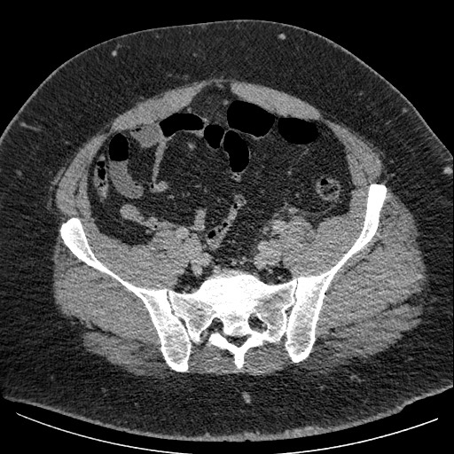 Burned-out testicular seminoma - retroperitoneal nodal metastases (Radiopaedia 62872-71245 A 56).jpg