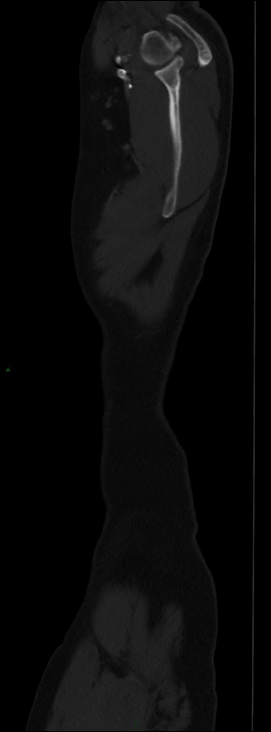 Burst fracture (Radiopaedia 83168-97542 Sagittal bone window 19).jpg