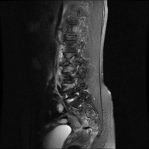 File:Burst fracture - lumbar spine (Radiopaedia 72877-83541 Sagittal STIR 1).jpg