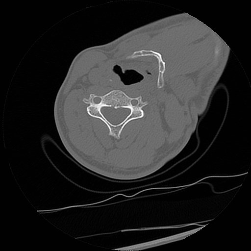 C1-C2 "subluxation" - normal cervical anatomy at maximum head rotation (Radiopaedia 42483-45607 Axial non-contrast 2).jpg