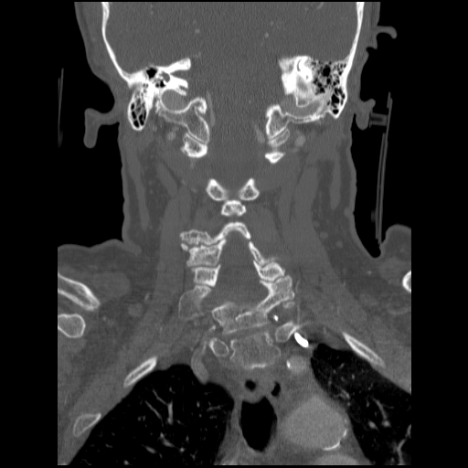 C1 anterior arch (plough) fracture - type 1 (Radiopaedia 76181-87720 Coronal bone window 43).jpg