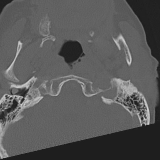 File:C2 fracture with vertebral artery dissection (Radiopaedia 37378-39199 Axial bone window 5).png