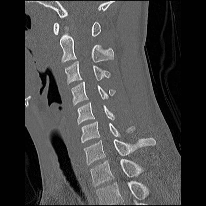 C5 facet fracture (Radiopaedia 58374-65499 Sagittal bone window 34).jpg