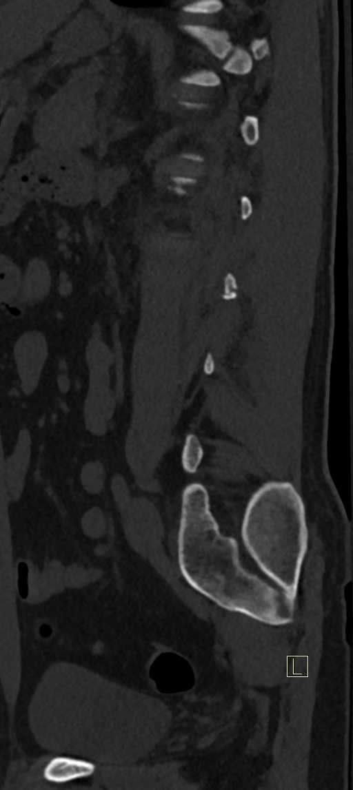 Calcaneal fractures with associated L2 burst fracture (Radiopaedia 71671-82493 Sagittal bone window 15).jpg
