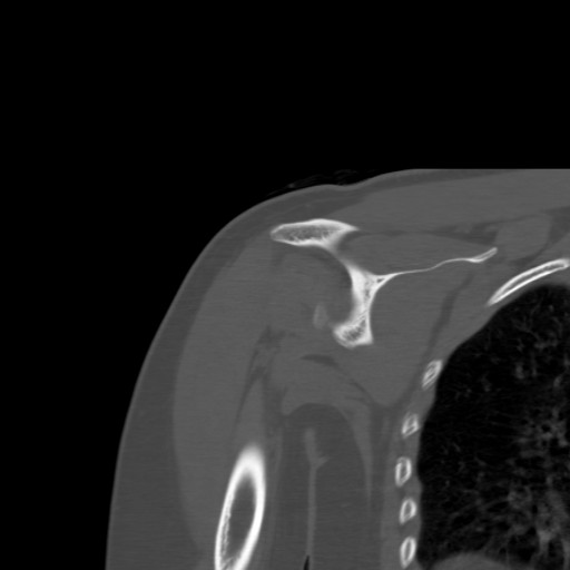 File:Calcific tendinitis of the infraspinatus tendon (Radiopaedia 87256-103539 Coronal bone window 34).jpg