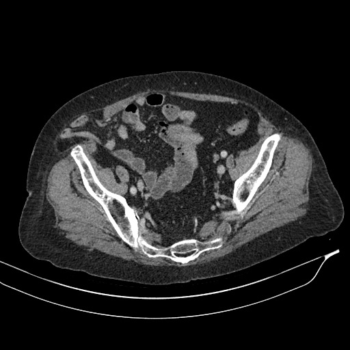Calcified adrenal glands and Spigelian hernia (Radiopaedia 49741-54988 A 192).jpg