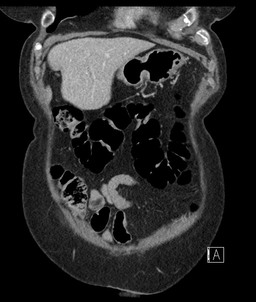 Calcified adrenal glands and Spigelian hernia (Radiopaedia 49741-54988 B 21).jpg