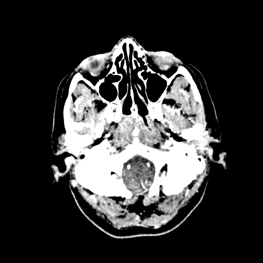 Calcified cerebral hydatid cyst (Radiopaedia 65603-74717 Axial with contrast 2).jpg