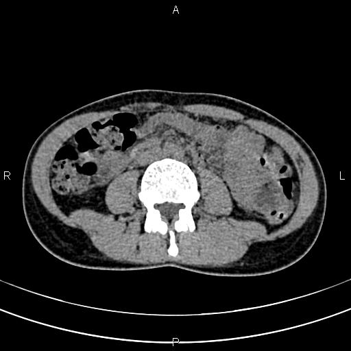 File:Calcified hepatic hydatid cyst (Radiopaedia 83870-99072 Axial non-contrast 98).jpg