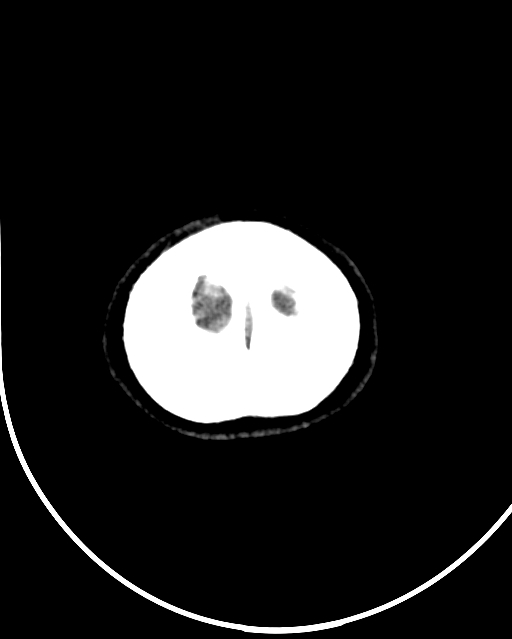 Calcified meningioma (Radiopaedia 74361-85243 Axial non-contrast 1).jpg