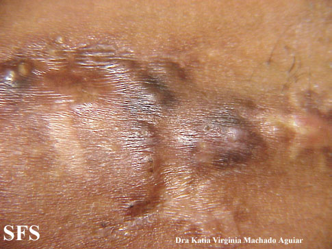 Calcinosis Circumscripta-Idiopathic (Dermatology Atlas 5).jpg