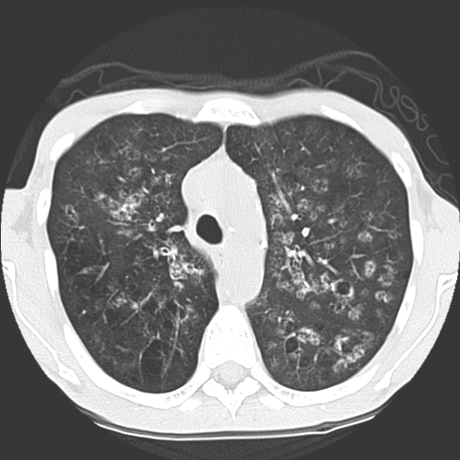 File:Calciphylaxis and metastatic pulmonary calcification (Radiopaedia 10887-11317 Axial lung window 12).jpg