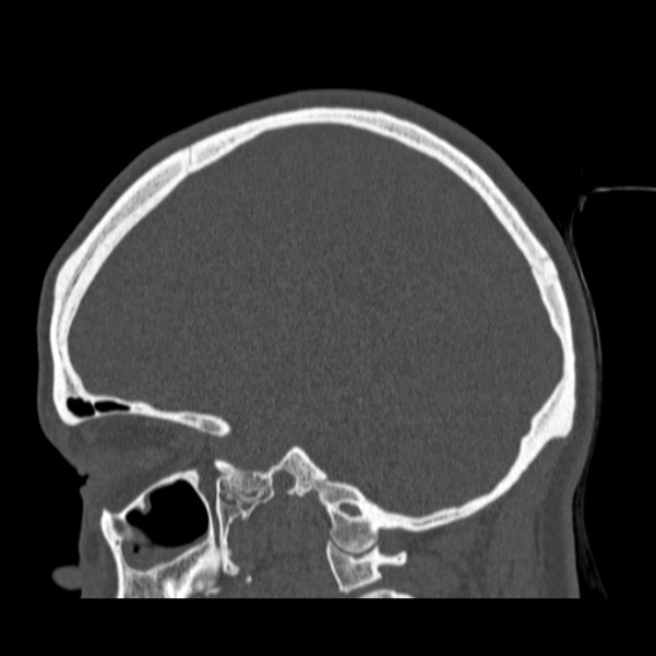 Calvarial osteoma (Radiopaedia 36520-38079 Sagittal bone window 44).jpg